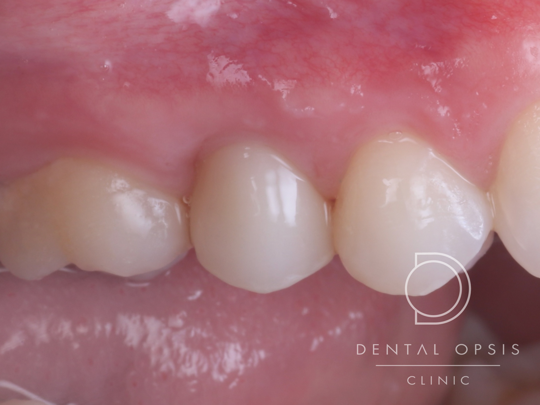 Extraction , Implant & Provisional in One Appointment